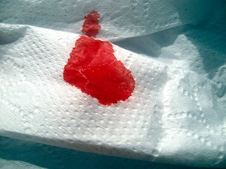 Kırmızı Kusmak Belirtileri ve Tedavisi